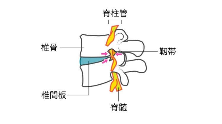 脊柱管狭窄症のモデル